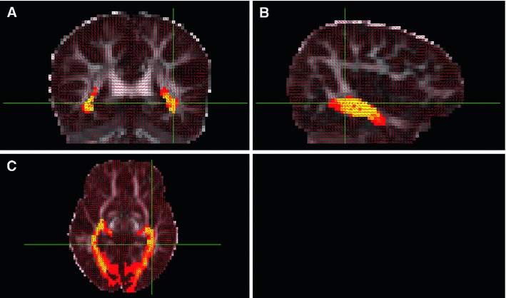 Real diffusion MRI tractography and probabilistic map
