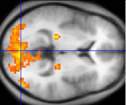 Real functional MRI activation map