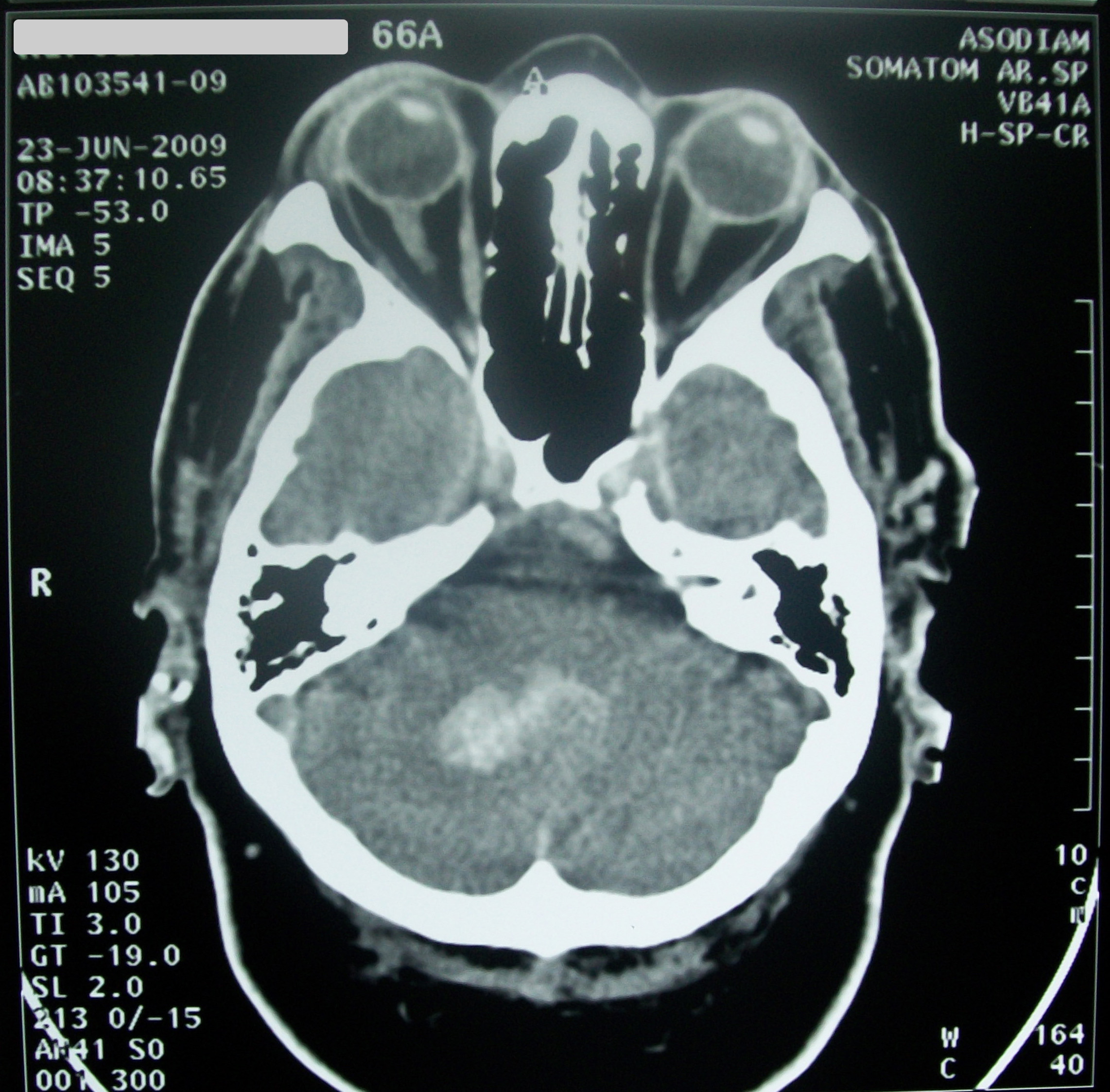 Real head CT showing an intracerebral haemorrhage