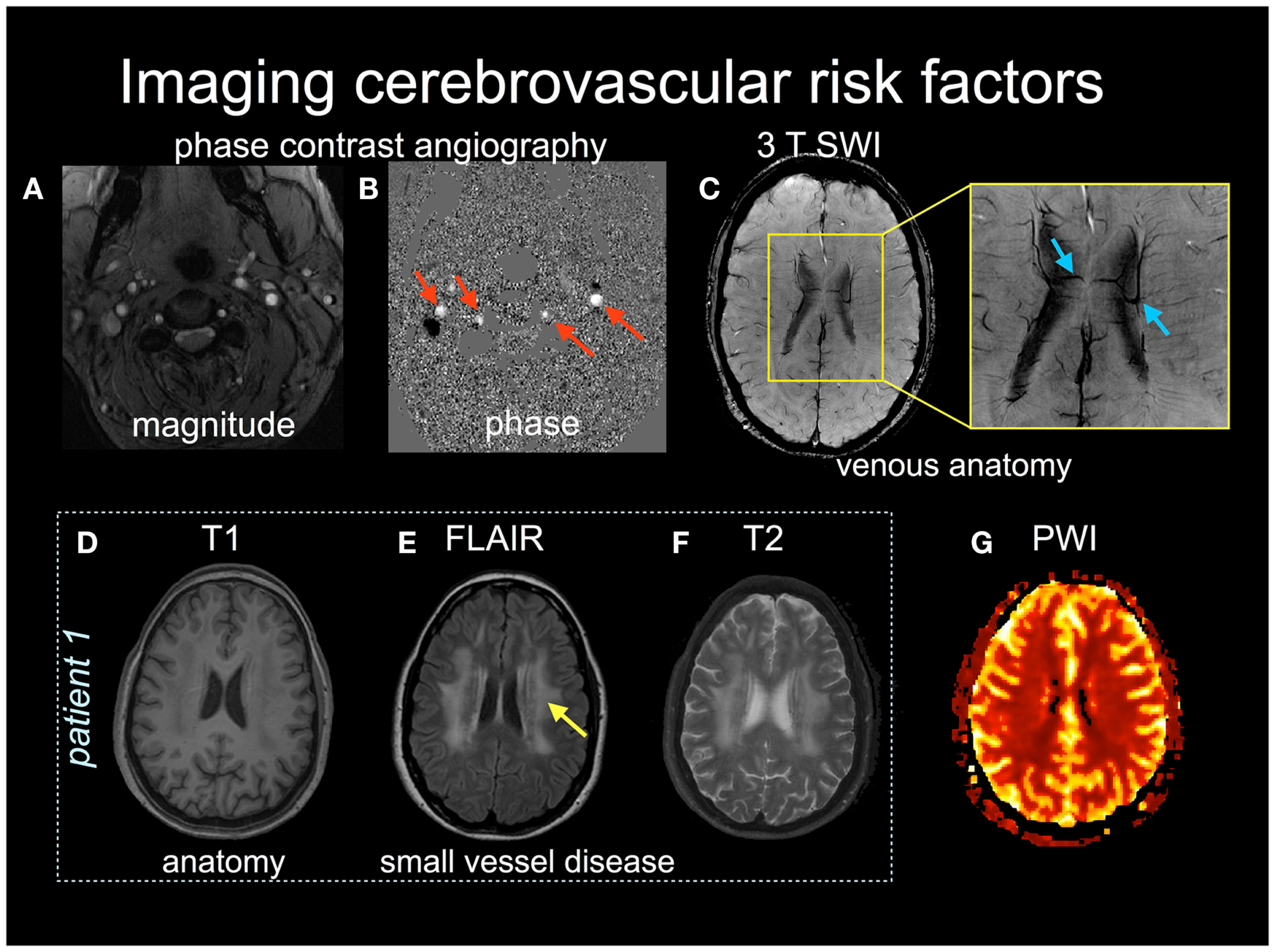 Examples of several MRI contrasts used in stroke imaging, including angiographic, susceptibility-weighted, T1-weighted, FLAIR, T2-weighted and perfusion-weighted images.