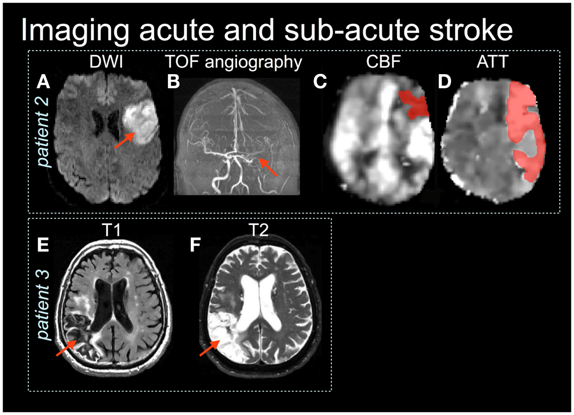 Acute and subacute stroke examples across diffusion, vascular, perfusion, T1-weighted and T2-weighted imaging.