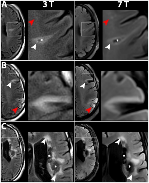 Chronic and subacute stroke lesions on FLAIR MRI acquired at 3 Tesla and 7 Tesla.