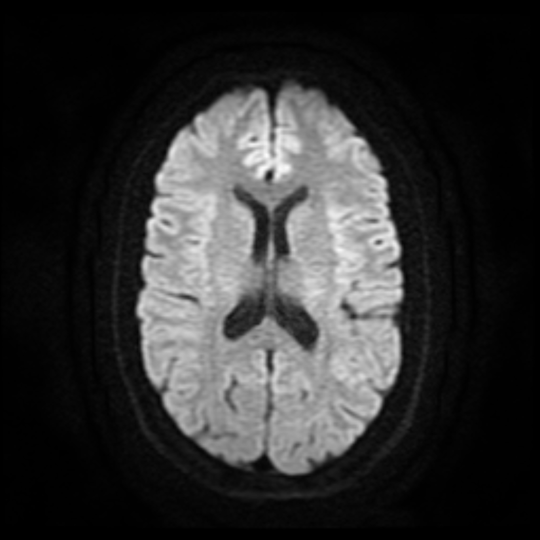 Real axial diffusion-weighted MRI