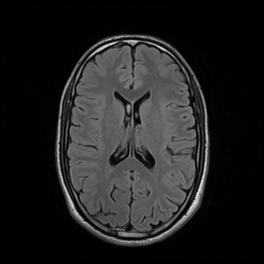 Real axial FLAIR MRI