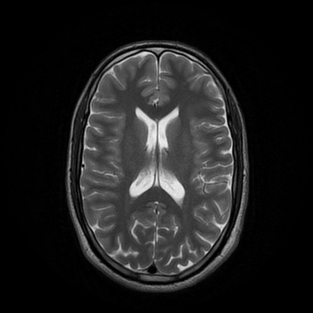 Axial T2-weighted MRI with tissue callouts